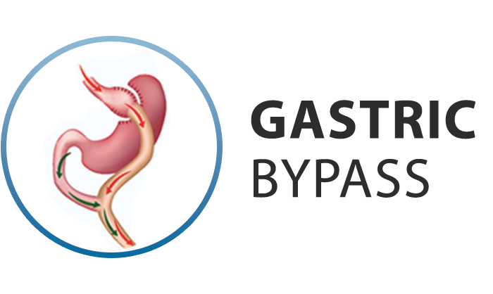 ib-serv-gastric_bypass