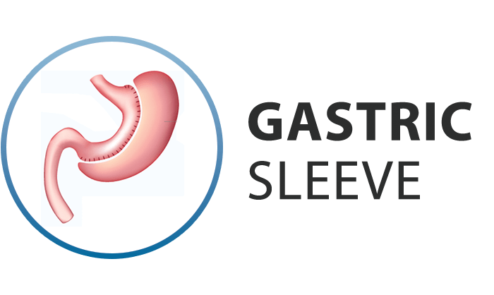 ib-serv-gastric_sleeve